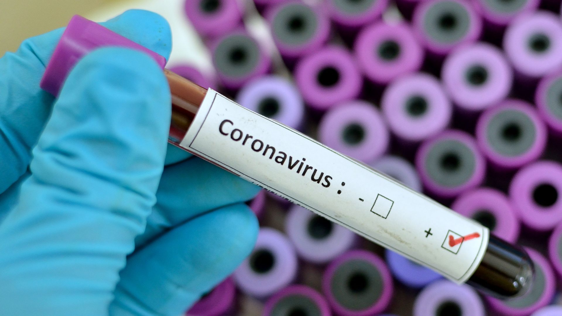 2020People Covid 19 coronavirus test tube in hand 142365